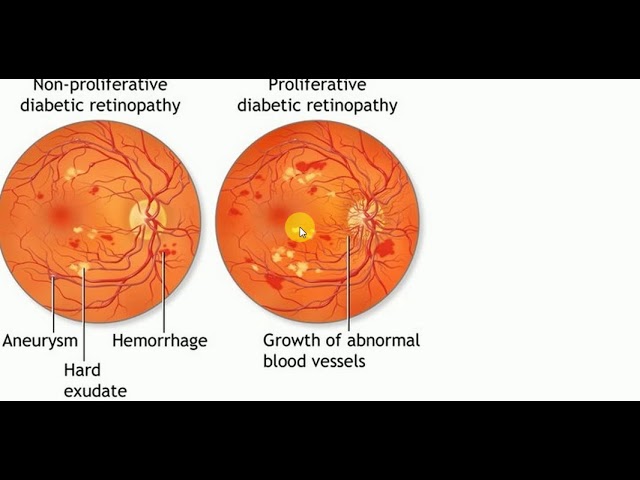 ophthalmology-2-diabetic-retinopathy-proliferative-diabetic-live